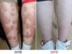 ţƤѢ����ͨ��ѪҺ�����д�Ⱦ��