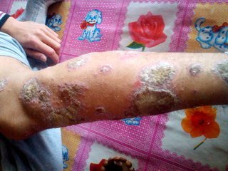 牛皮癣患者要怎么来选择药物